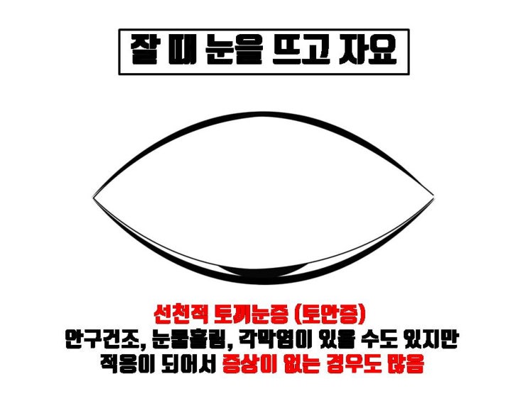  눈이 덜 감기는 토안증이 있으면 쌍수하면 안 되는 눈인가요?