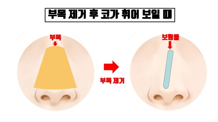  코수술 후 부목을 제거했는데 콧대가 휘어 보여요. 당황할 필요 없으세요.