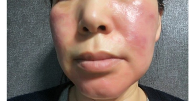  타는듯한 얼굴열감 홈케어로 잡은 사연
