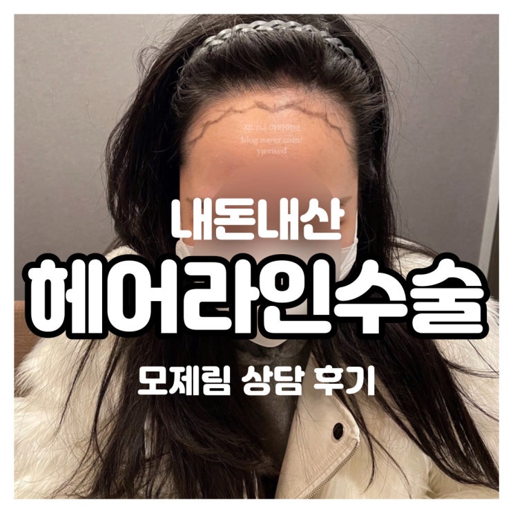  내돈내산 헤어라인수술 모발이식 상담 후기(모제림)