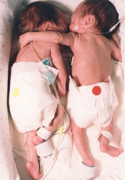  쌍둥이 형의 심장박동이 쌍둥이 동생 살린 이야기와 이름치료