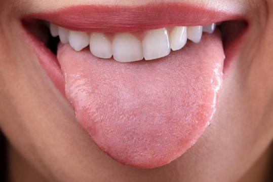  혓바늘 없애는법, 원인 알보칠 사용해보자