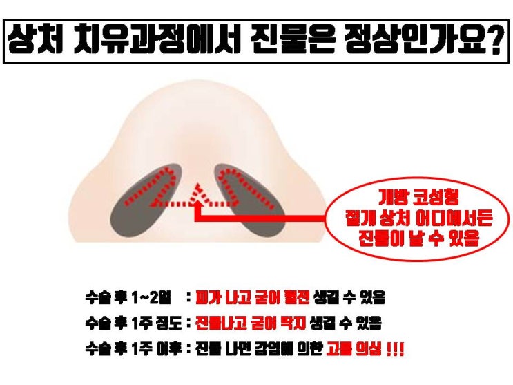  코수술 상처에서 진물이 나면 무조건 코수술 염증인가요?