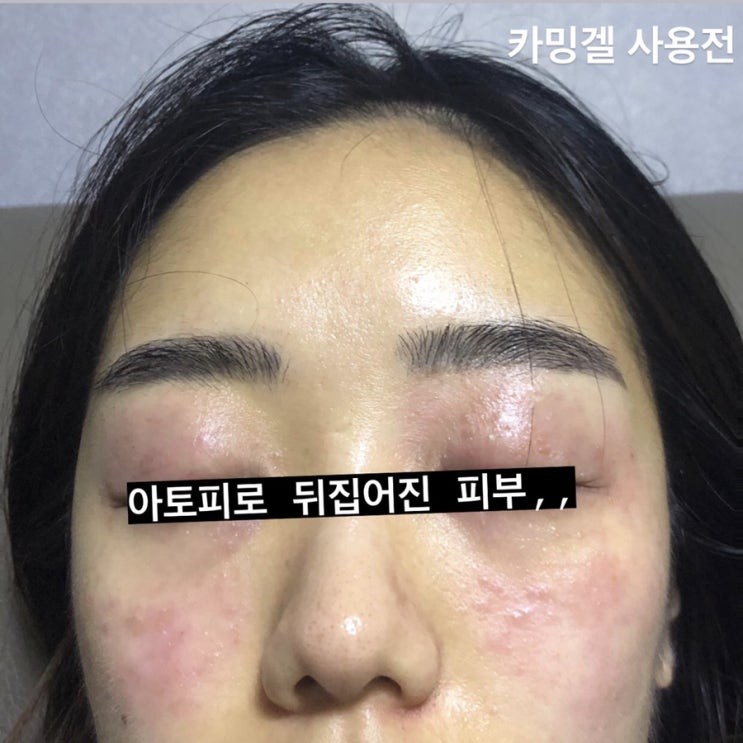  일명 화이트헤드 블랙헤드 피지 타파 SET 99000 럭키 박스 ️️️