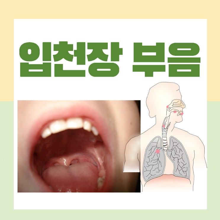  입천장 부음 단지 염증일까요?