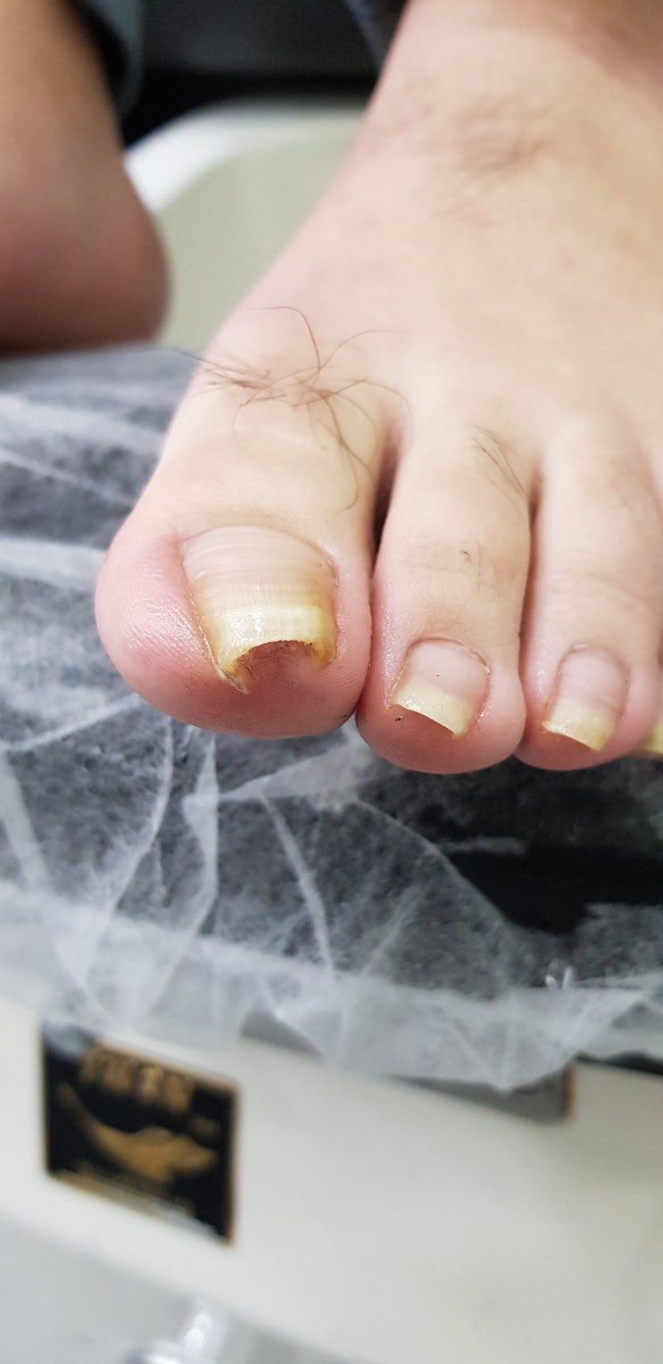  수원 행궁동 내성발톱, 무좀발톱, 발각질 14년째된 네일샵에서 깔끔하게!