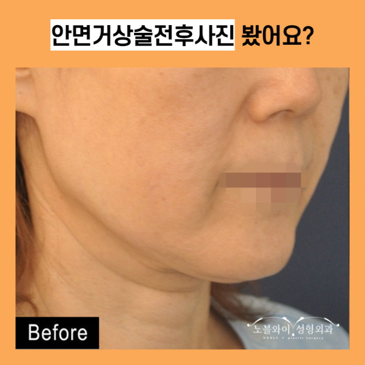  안면거상술전후사진 봤어요