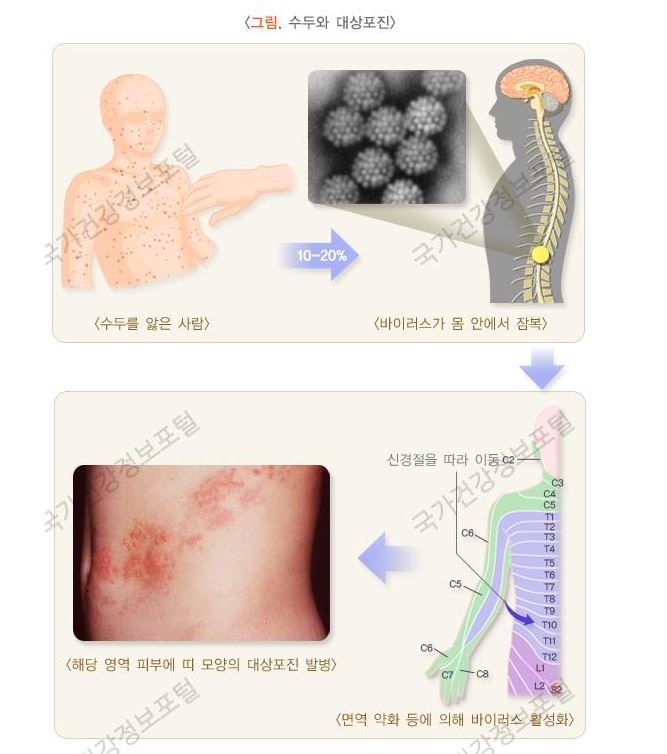  갑작스런 옆구리통증 대상포진이 의심된다면