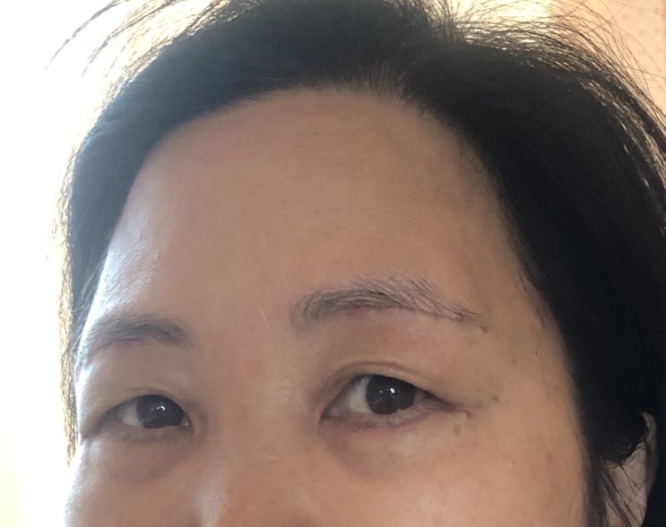  한달차) 내돈내산 우리엄마 하안검수술 + 눈썹거상술 후기