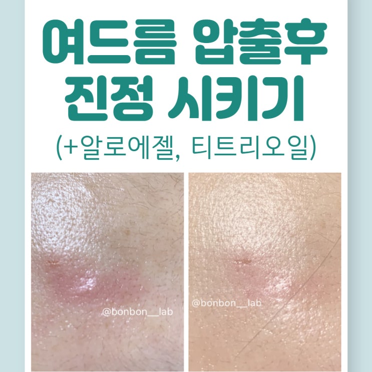  여드름 압출 후 진정관리 팁 (화농성, 뾰루지, 천연 알로에 티트리 팩)