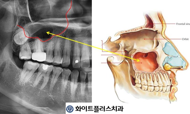  치주염 방치시 상악동염이 생기는 이유 (보라매역 잇몸치료하는 치과)