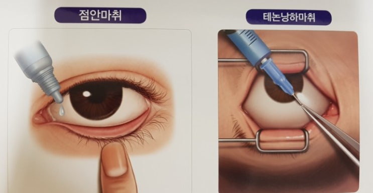  [백내장3편] 백내장 수술 마취방법, 백내장 수술 (구후마취, 테논낭하마취, 공막고정술,홍채고정술 등)
