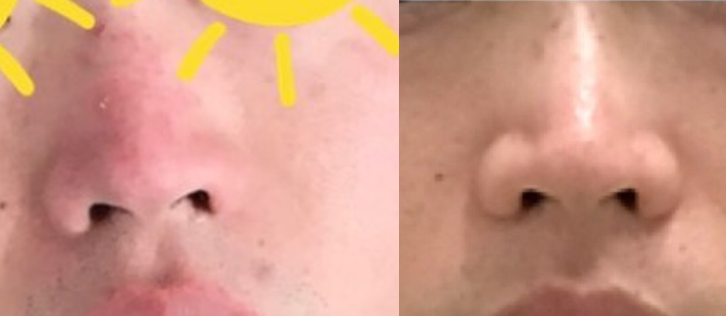  딸기코 3달만에 회복(+실제사진)