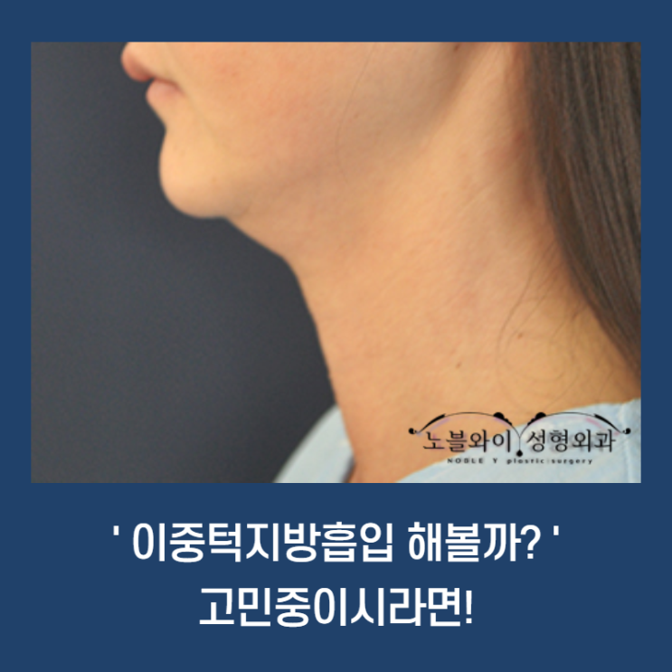  이중턱 지방흡입 후회 수술로 다시