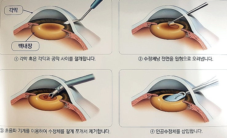 봉은사역안과 백내장 전신마취수술이 호전된 사례