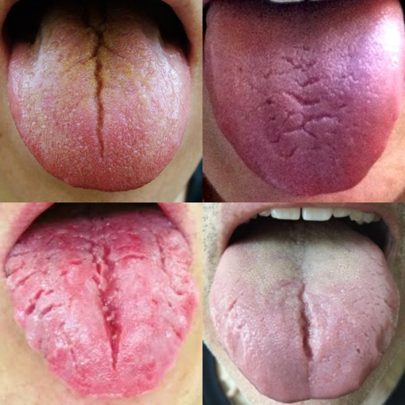 구강작열감증후군 혓바닥에 통증과 6