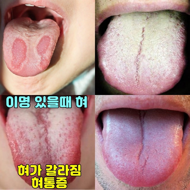 구강작열감증후군 혓바닥에 통증과 8