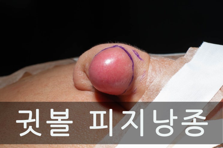  귓볼 피지낭종 '고약한 냄새와 하얀 피지'