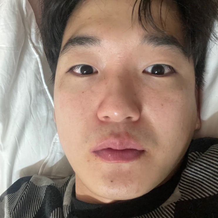  부산 남자 코수술 코성형 12일차 ! 아바타, 인면어 , 고슴도치 주의