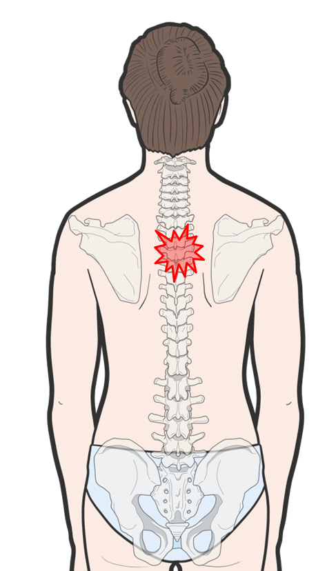 날개뼈 사이 등 가운데 통증 - 흉추의 전방 아탈구, 흉추 전방전위 추나 교정 요법 - 가로세로 한의원 일산점