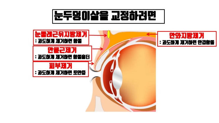  절개 쌍수할 때 눈두덩이 살은 눈두덩이 지방 제거만 해서는 절대로 교정 안 돼요 !!!