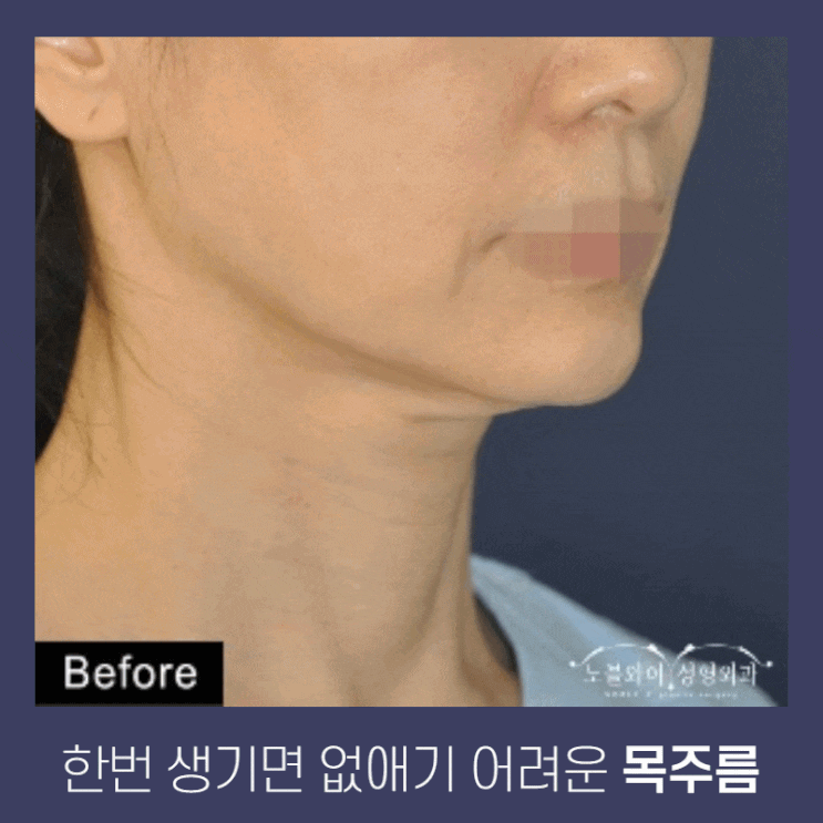  목주름제거수술 유지기간도 길어 문의폭주