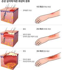 화상응급대처 피부부위소독드레싱 간호진단중재 감염피부이식