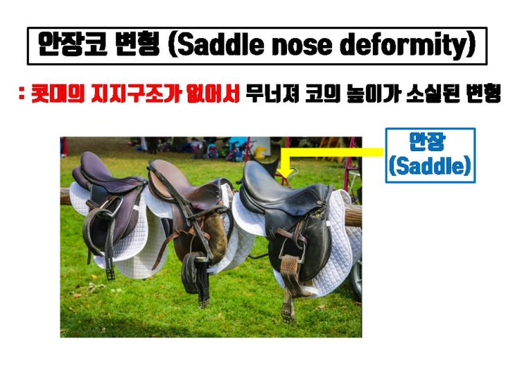  콧대의 중간 부분이 주저 앉아 말안장처럼 보이는 최악의 코수술 부작용 안장코 변형