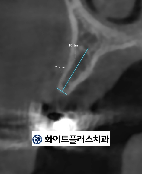  (신풍역/ 신길뉴타운 치과 )좁고 얇은 잇몸뼈에서의 뼈이식 수술과 임플란트