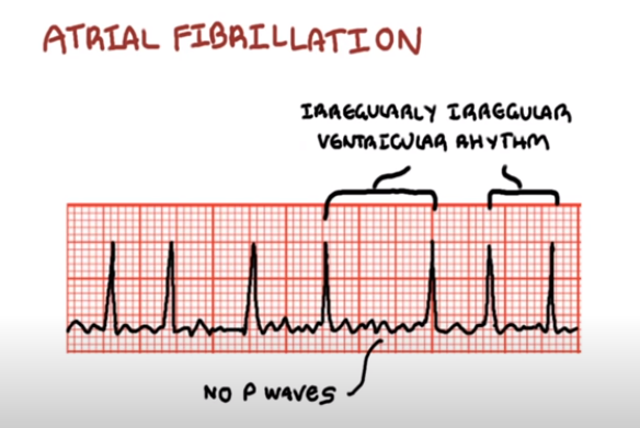 [심전도/EKG] 심방세동 A-fib CVR, RVR, SVR : 네이버 블로그
