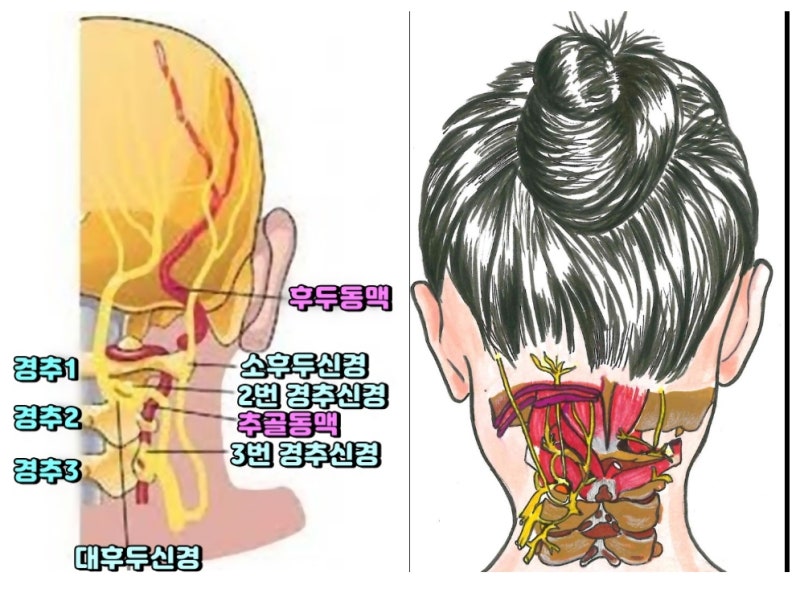 왼쪽 엉덩이 뒤쪽이 아픈 이유 - 긴장성 두통, 스트레스 해소