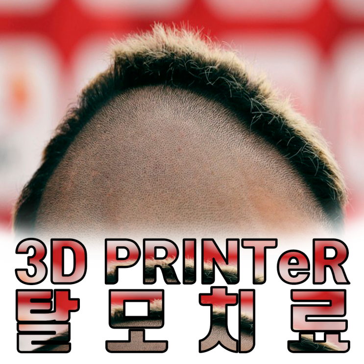  탈모 치료 3D프린터로 극복 할 수 있을까?