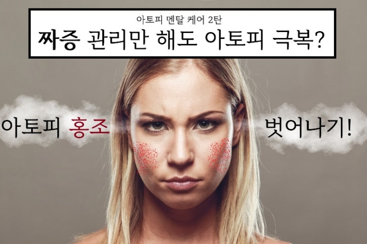  짜증만 잘 조절해도 아토피홍조 탈출!
