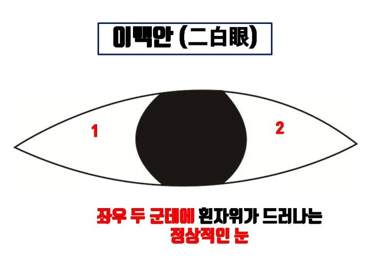  주의!!  쌍수나 눈매교정 후 삼백안 생길 수 있어요!!!