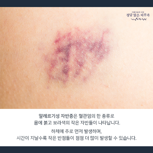 인천알레르기 자반 한약 붉은 반점 원인을 알아보자 2