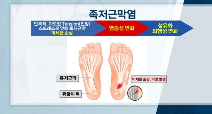  찌릿! 발뒤꿈치 통증 (족저 근막염)