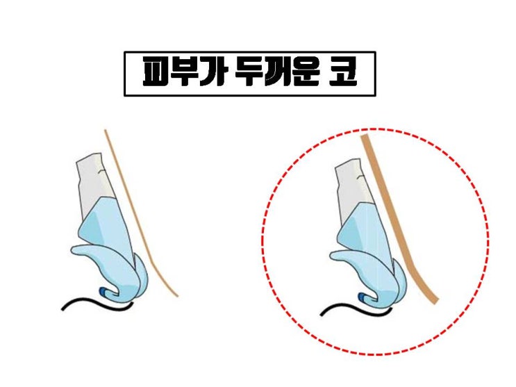  코수술 결과 기대치를 조금 낮춰야 하는 코성형 어려운 조건 5가지