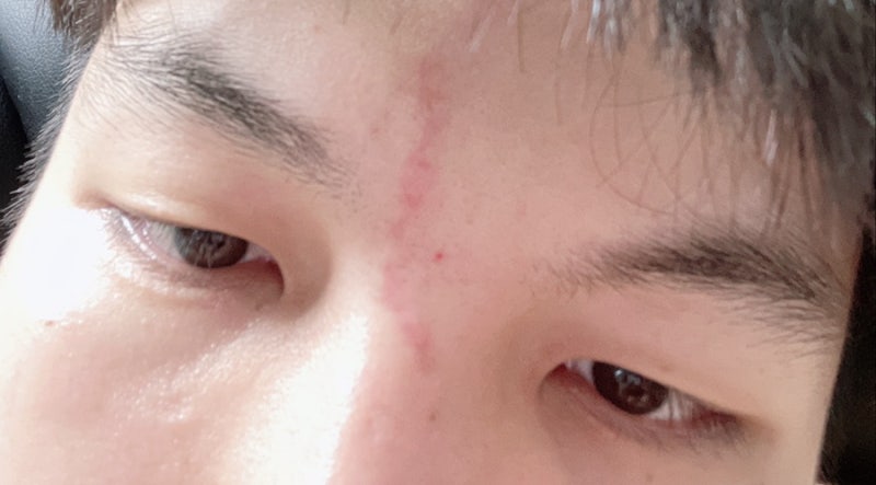 어린이 흉터 수술, 도그이어 제거 수술 국소 마취 및 낮잠 수술 리뷰 8