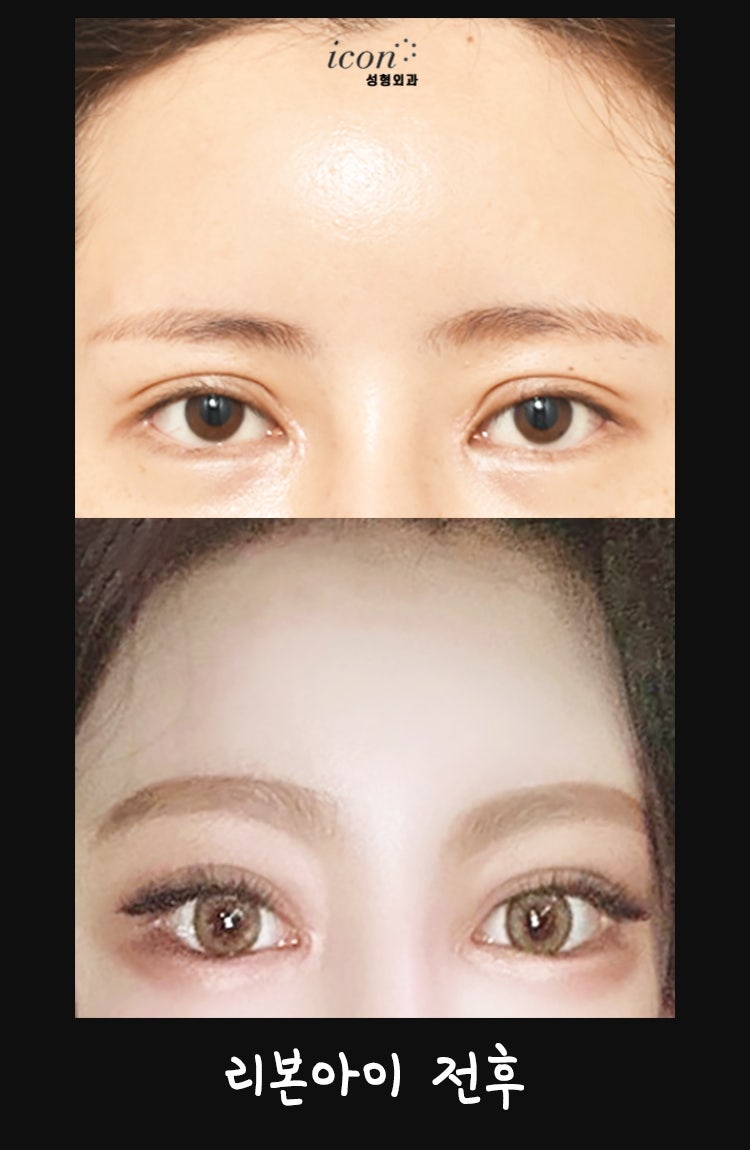 이마거상술후기 6년 넘은 3