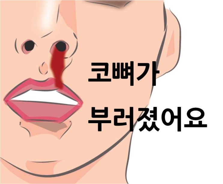  주먹으로 코를 맞은 30대 직장인 [코뼈 골절]