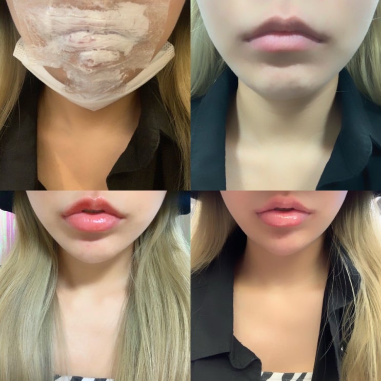  신사 어린공주성형외과 입술필러시술 두근두근 내돈 솔직 후기