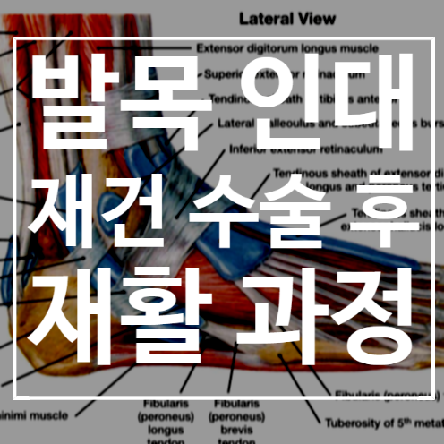  발목 인대 재건 수술 재활 과정