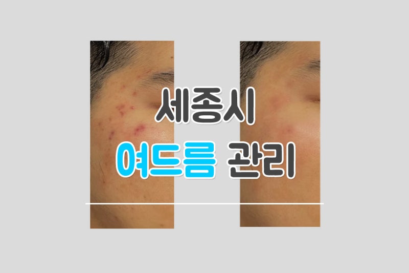 세종피부과 여드름? 원장님의 3가지 핵심 포인트