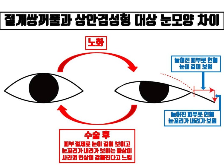 절개 쌍꺼풀 수술과 상안검 수술은 같은 눈성형 같지만 다른 눈수술!!!