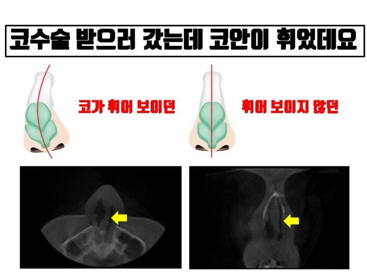  코성형 위한 성형 상담 시 코안이 휘어서 수술이 필요하다는 말 누구나 들을 수 있는 말이에요. 신경 쓰지 마세요.