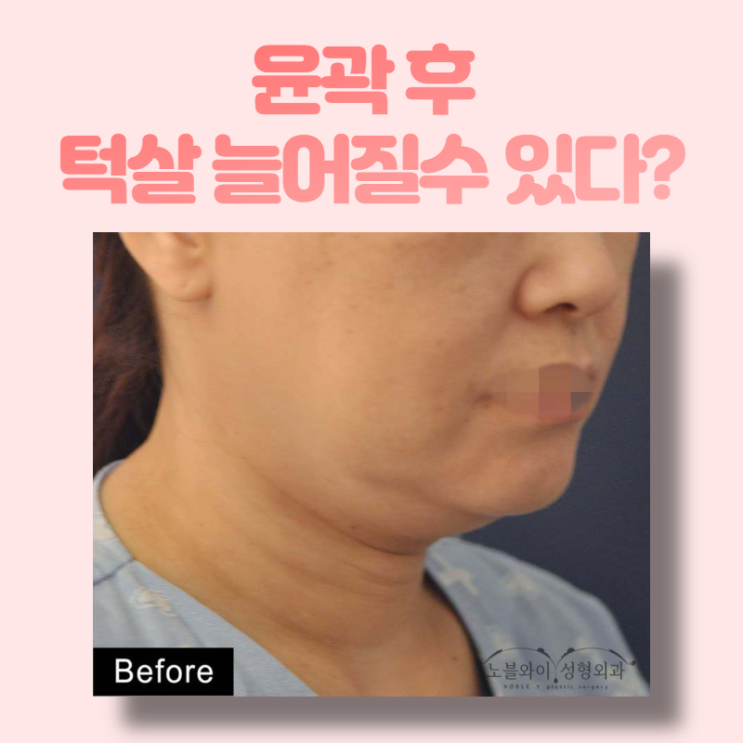  늘어진턱살리프팅 윤곽후 턱살이 처졌다