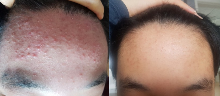  중학생 사춘기여드름 완젼 좋아졌어요