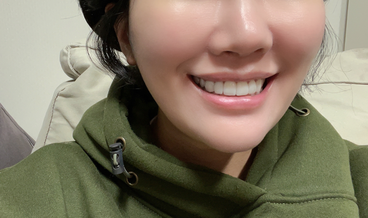  라미네이트 삭제 없이 앞니 벌어짐 + 토끼이빨 벗어난 후기