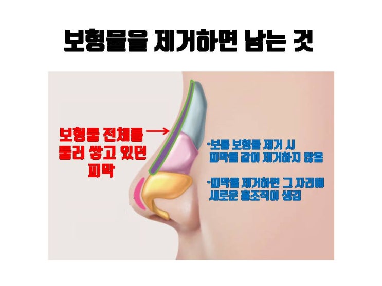  코보형물을 제거하면 코수술전의 콧대보다 조금 높아지는 거죠?     콧대 흉살로 코성형 전보다 펑퍼짐해 보일 까요?