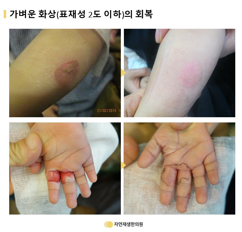 3도 화상 흉터 관리(정말 한 번도 안 되지만)는 계속 노력해야 할 것 같다. 2